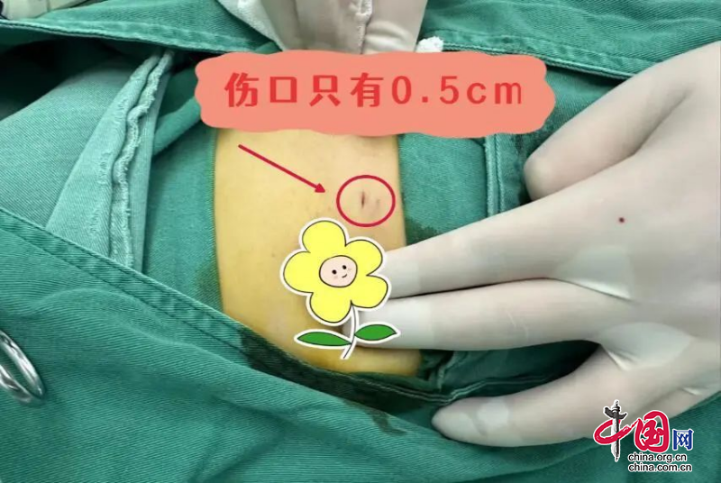 广元市中医医院：微创旋切10分钟搞定乳房3个包块